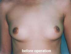 plastic-surgery-breast-augmentation 